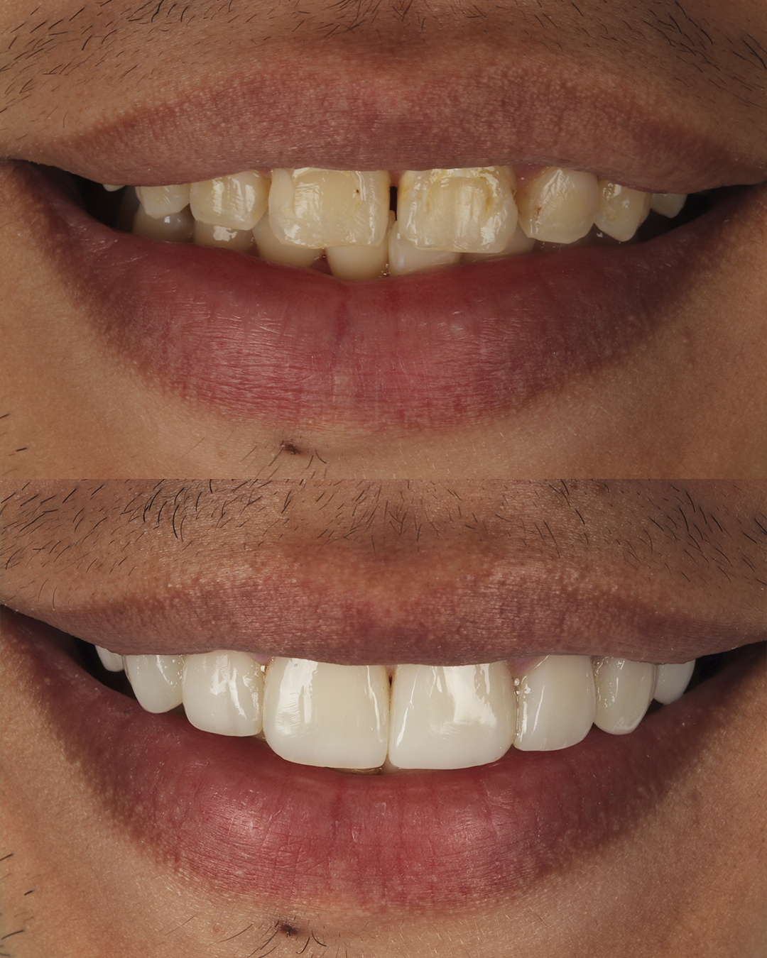 Antes e Depois - 01