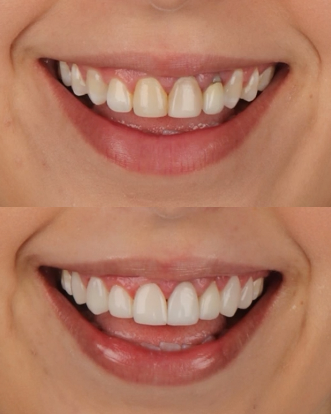 Antes e Depois-1