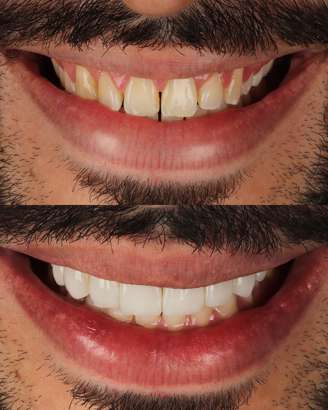 Antes e Depois-2