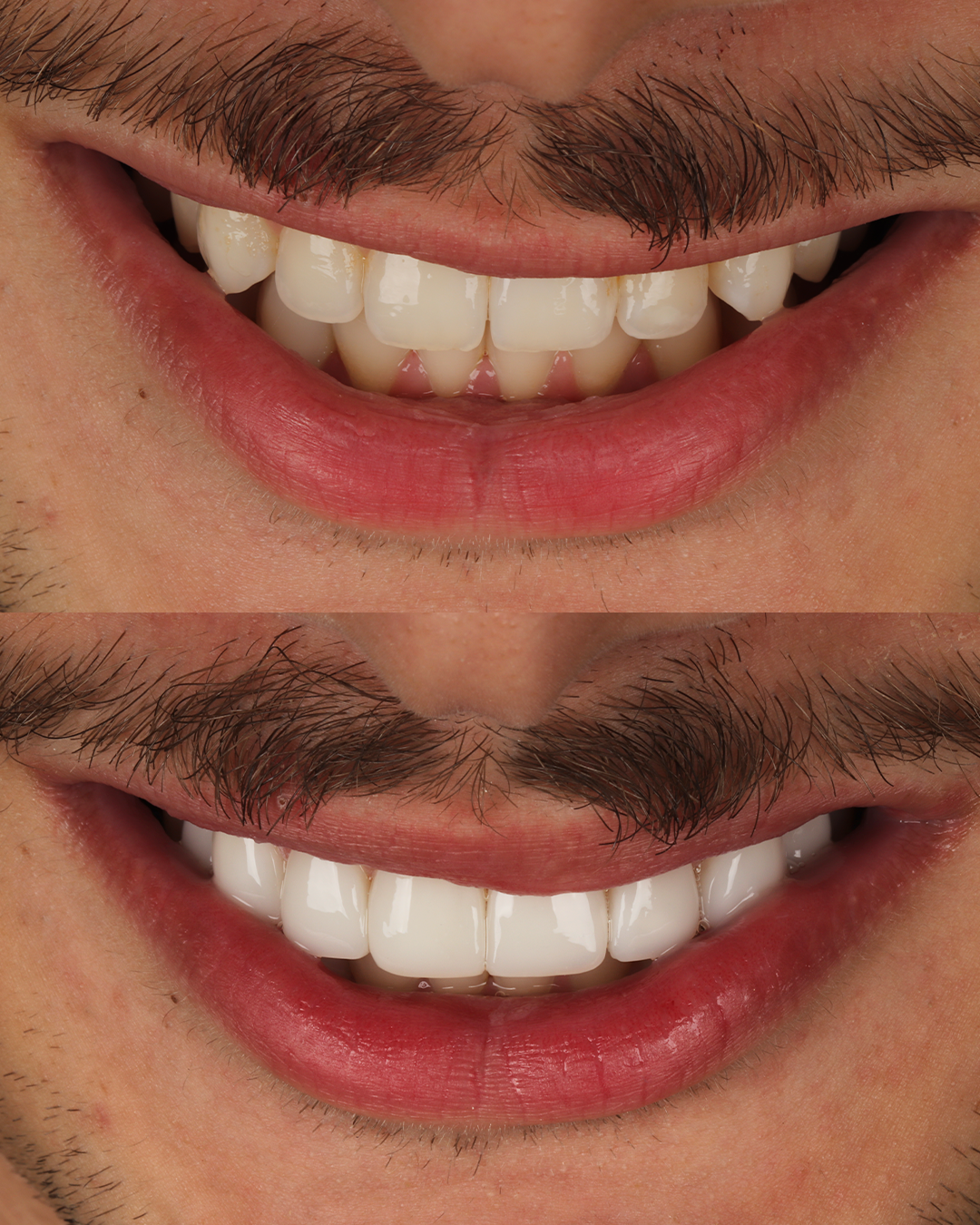 Antes e Depois-3