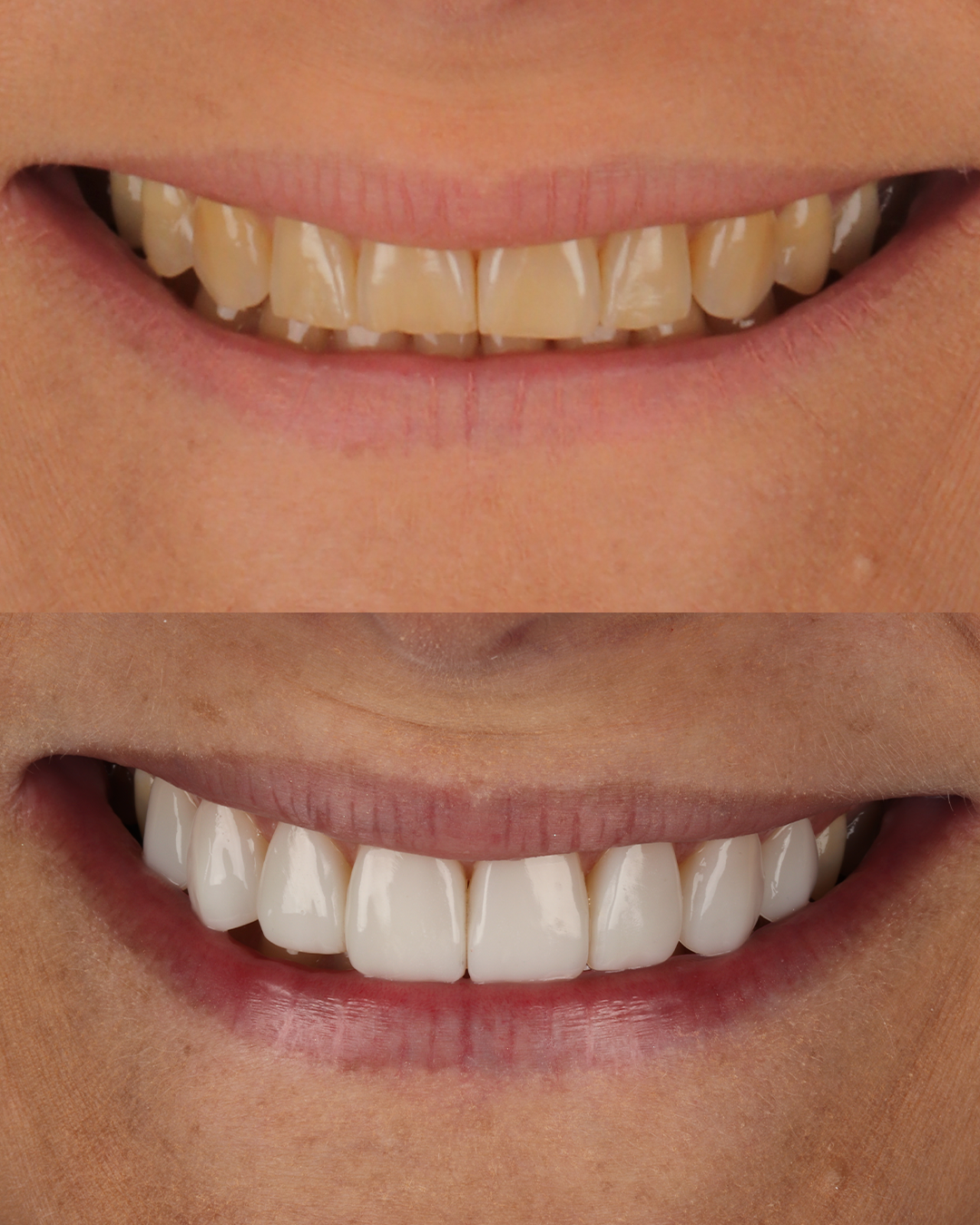 Antes e Depois
