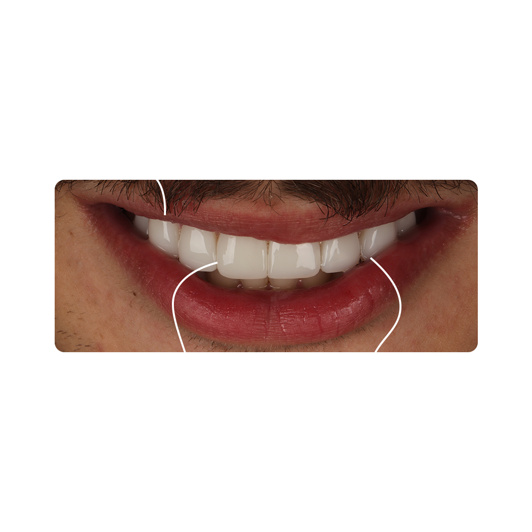 Depois
